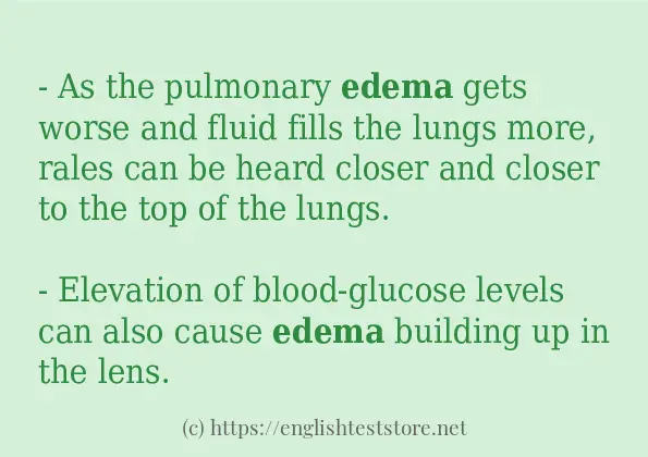 In sentence use of edema